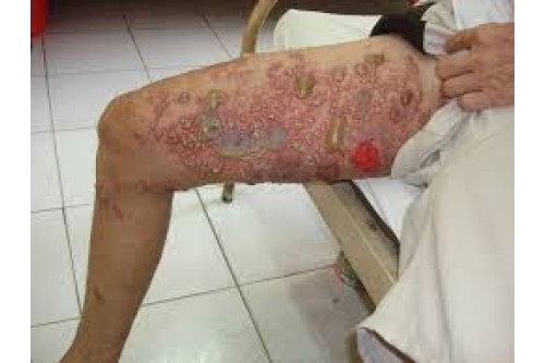 Cách trị giời leo bằng mẹo dân gian nhanh nhất không bị sẹo